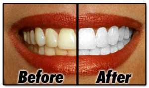    Crest Whitestrips, 