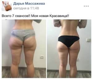 Вакуумный антицеллюлитный массаж - объявление
