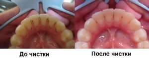 Исключительная и профессиональная чистка зубов
