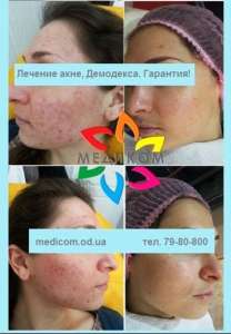 Лечение Демодекса с гарантией! - объявление