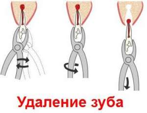 Новая технология - удаления зубов - оголошення