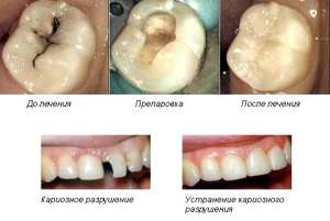 Предлагаем лечение кариеса зубов