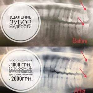 Удаление зубов мудрости - объявление